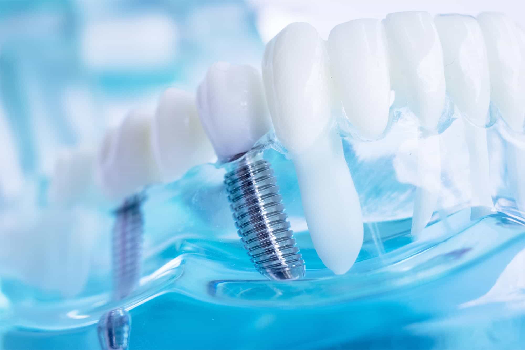 Implant Materials: Titanium vs. Zirconia – A Comprehensive Comparison