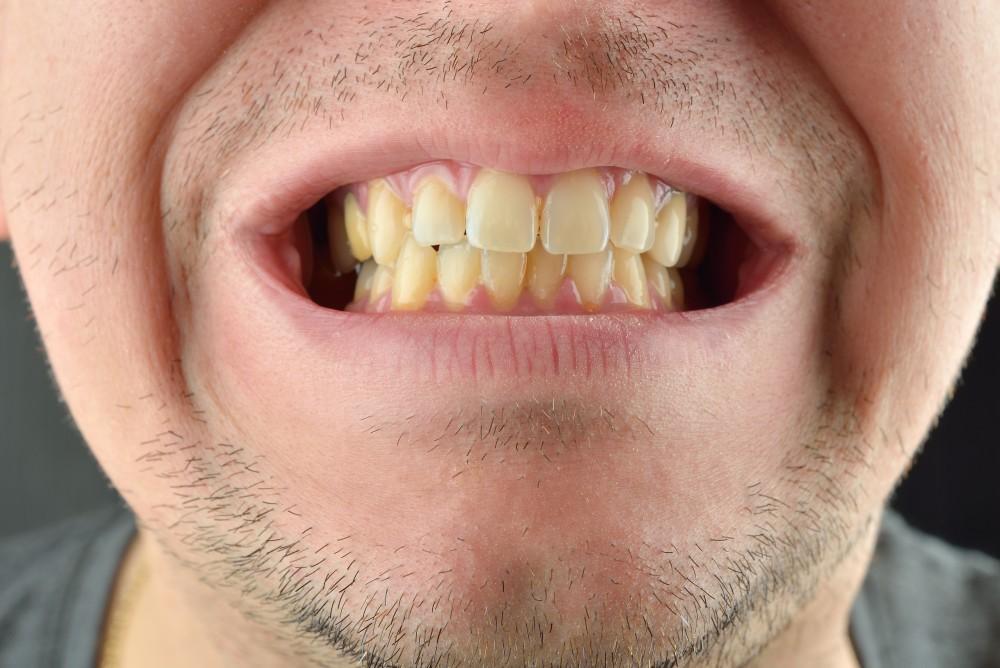 What are the Causes of Yellow Teeth, and How to Prevent Them? 