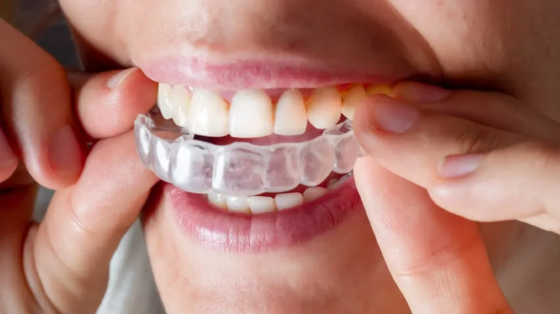 Invisalign Clear Aligners – Comfort And Convenience 